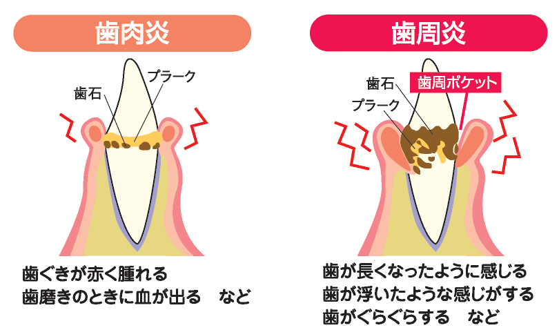 歯周炎と歯周病の違い